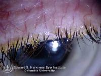 External Hordeolum (Stye)